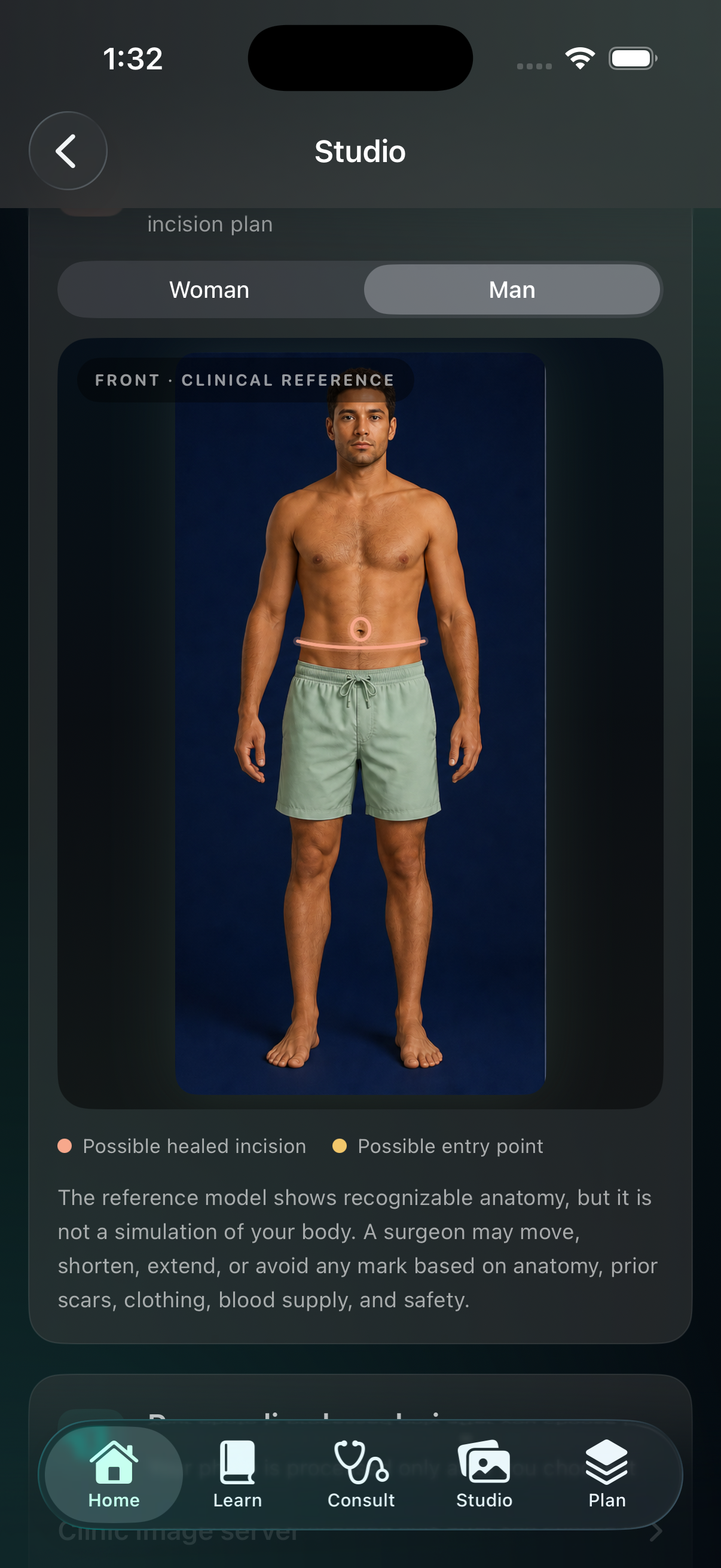 ShapeShift: Aesthetic Architect Scar Reality Atlas showing an educational tummy tuck incision zone on a realistic male clinical reference.